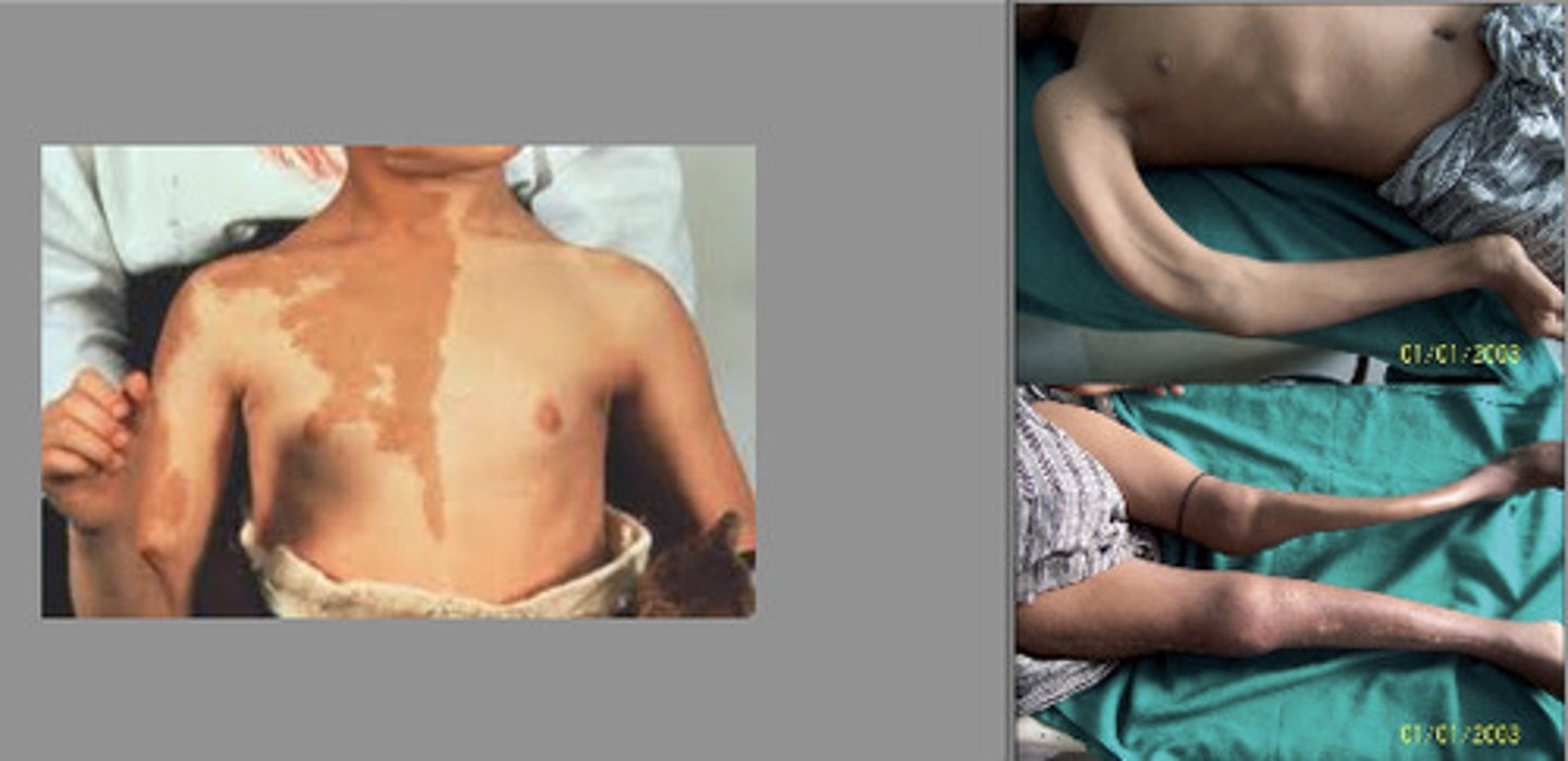 <p>McCune-Albright syndrome</p><p>(mosaicism, G-protein signaling mutation)</p>