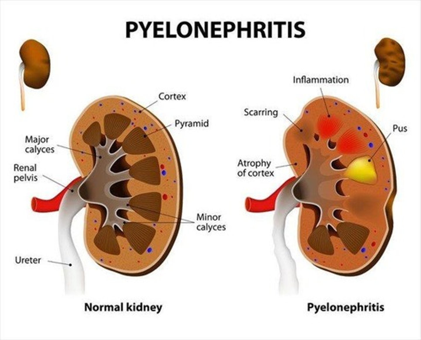 <p>Inflammation of the kidneys; Pyelonephritis is inflammation of the renal parenchyma; E. coli is the most common cause.</p>