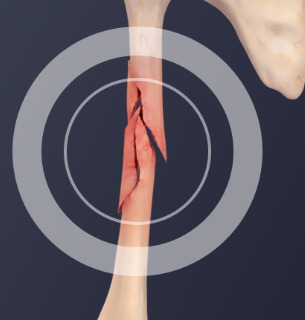 <p>ends of broken bone are shattered into many small pieces</p>