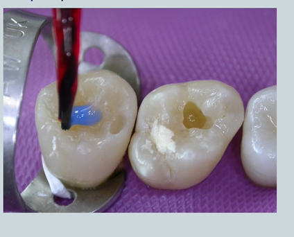 <p>37% phosphoric acid is used to ‘<strong>etch</strong>’ enamel to create a rough surface for bonding </p>