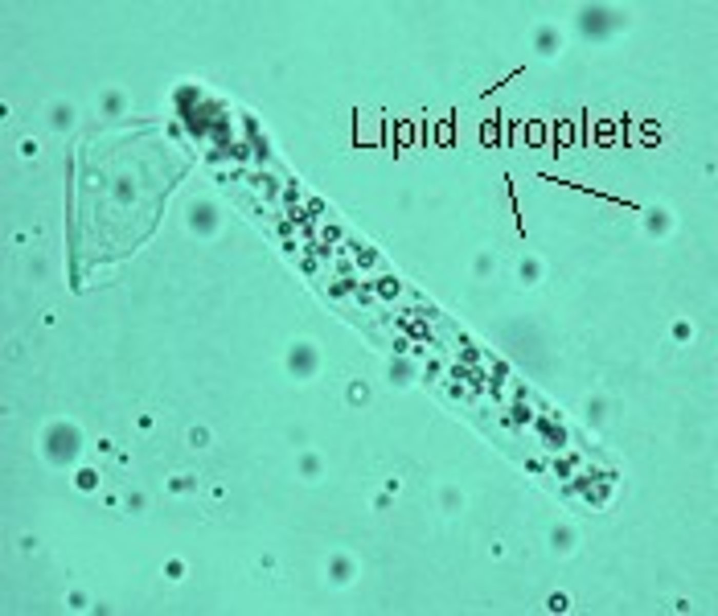 <p>Fatty Cast</p><p>-Maltese crosses with polarized light if</p><p>lipid is cholesterol.</p><p>-Sudan III &amp; Oil Red O stain triglycerides &amp; neutral fats</p>