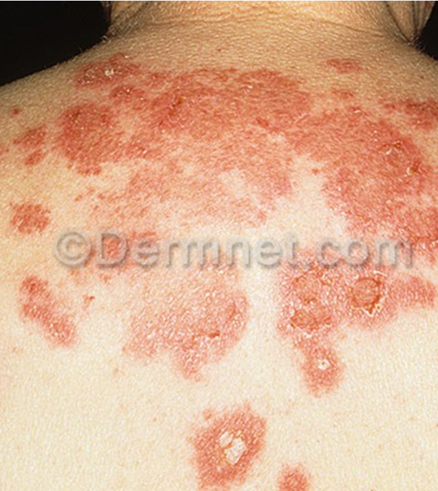 <p>Pemphigus Foliaceous </p>