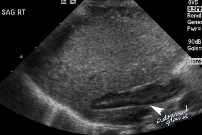 <p><mark data-color="yellow" style="background-color: yellow; color: inherit;">renal agenesis</mark></p>