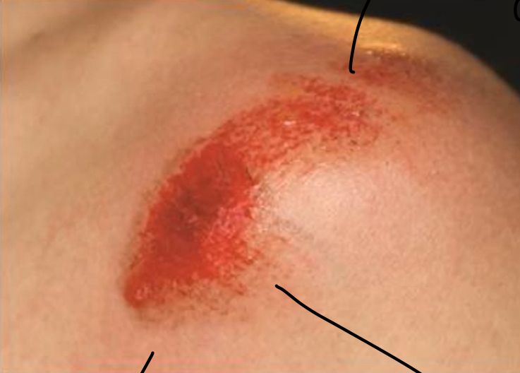 <p>Very red, capillary beds close to skin, may/may not bleed, can get from tarmac </p>