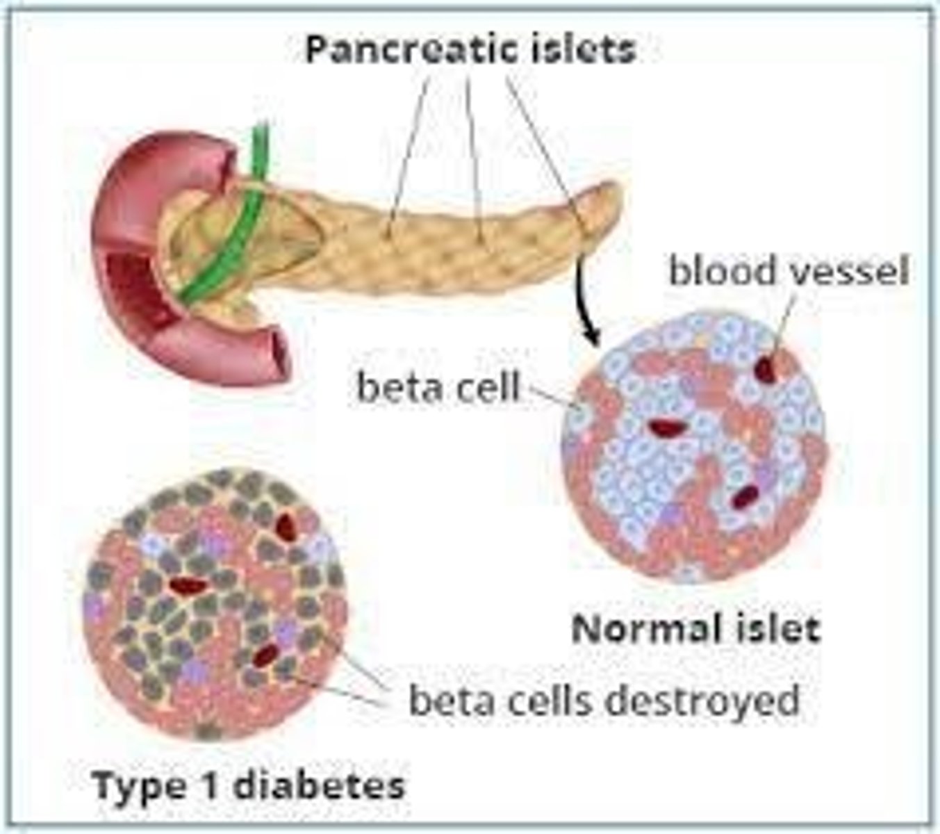 <p>Type 1 Diabetes.</p>