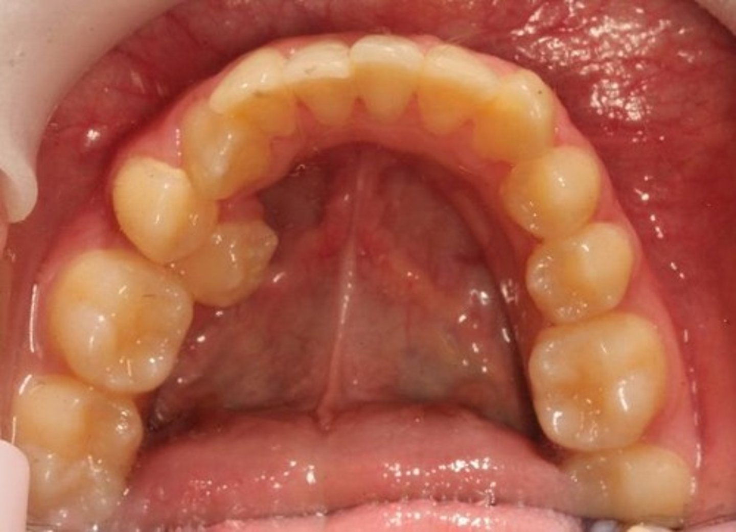 <p>Insufficient space for teeth in the dental arch.</p>