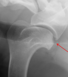 <ul><li><p><strong>Cause</strong></p><ul><li><p>dysfunction of endochondral ossification</p></li><li><p>thick weak cartilage</p><ul><li><p>chips off</p></li></ul></li></ul></li><li><p><strong>CS</strong></p><ul><li><p><strong>young </strong>Lg breed males</p></li><li><p>front limb lameness</p></li></ul></li><li><p><strong>Location</strong></p><ul><li><p><strong><u>Shoulder (#1): caudal or caudal-lateral humeral head</u></strong></p></li><li><p><strong><u>Elbow: distal medial humeral condyle</u></strong></p></li><li><p><strong><u>Stifle: distal lateral femoral condyle</u></strong></p></li><li><p><strong><u>Tarsal: medial trochlear ridge of the talus</u></strong></p></li></ul></li><li><p><strong>RS</strong></p><ul><li><p><strong>Calcified</strong> flap of articular <strong>cartilage</strong>, secondary DJD, Joint effusion</p></li></ul></li><li><p><strong>DDx</strong></p><ul><li><p>long digital extensor fossa can be confused for an OC lesion</p></li></ul></li></ul><p></p>