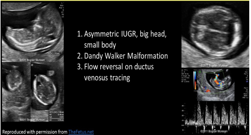 <p>an 18w fetus shows syndactyly, dandy walker malformation, asymmetric IUGR, and flow reversal in ductus venosus.</p><p>.</p><p>a) trisomy 13</p><p>b) triploidy</p><p>c) apert syndrome</p><p>d) turner syndrome</p>