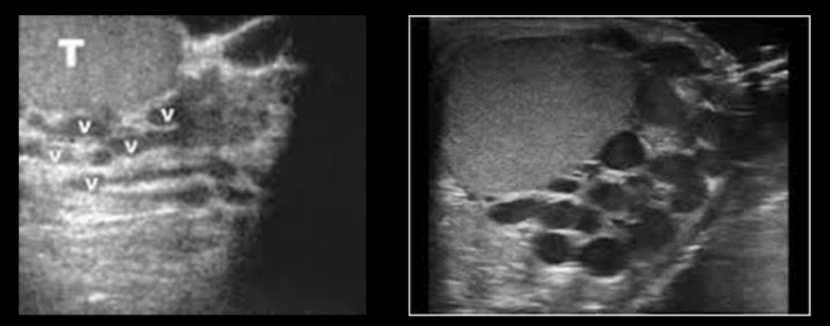 <p>What does the following describe?</p><p>– are much less common and result from increased pressure in testicular vein&nbsp;due to</p><p>•compression (e.g. extrinsic mass),&nbsp;</p><p>•obstruction (e.g.&nbsp;renal vein thrombus),</p><p>•splenorenal shunting (portal hypertension).&nbsp;</p>