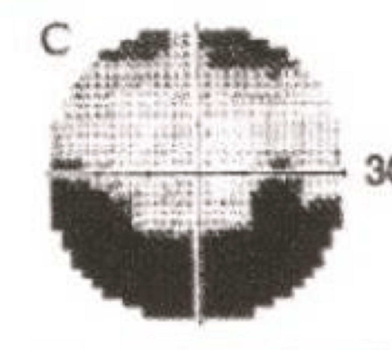 <p>What type of monocular pre-chiasmic VF defect is present in the given image?</p>