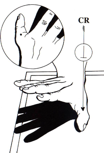 <p>lateral thumb</p><ul><li><p>hand PA then fist with thumb out&nbsp;</p></li></ul><p></p>
