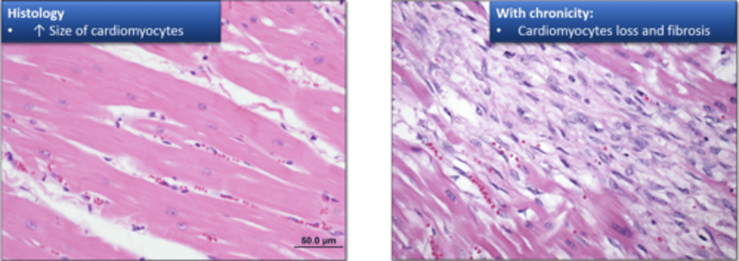 <p>What are the cellular stages of cardiac hypertrophy?</p>