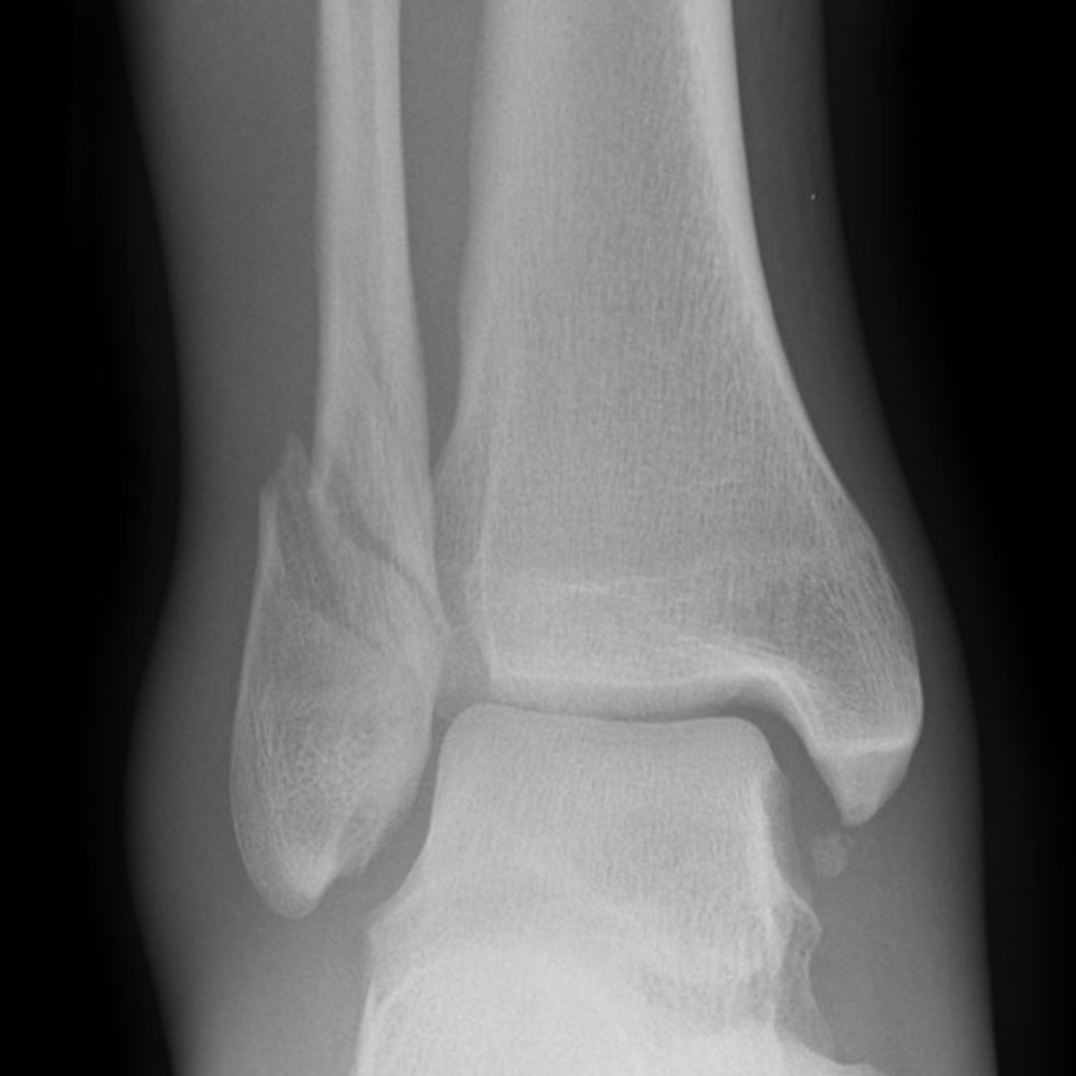 <p>1. MC distal fibula fx<br>2. oblique or spiral fx m/c<br>3. result of outward or external rotation of foot</p>