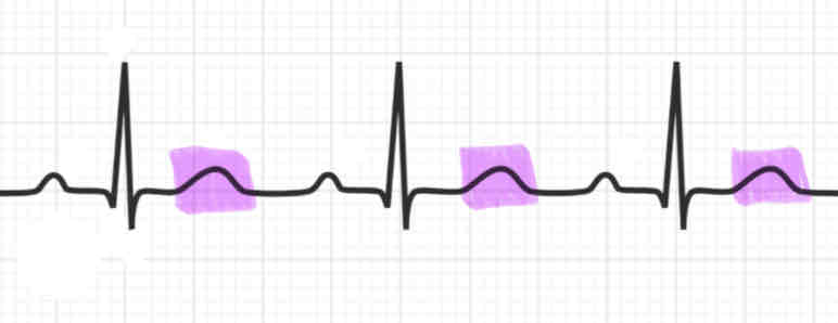 <p><strong><em>(Note: Explain what is happening during each)</em></strong></p><ul><li><p><span>the final small peak is called the </span><strong>T wave</strong></p></li></ul><ul><li><p><span>the ventricles are repolarizing and relaxing</span></p></li></ul><p></p>