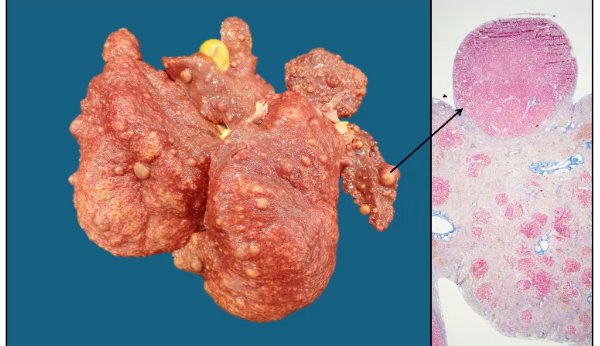 <p>This is an example of a poison causing spongiosis. What is this called?</p>