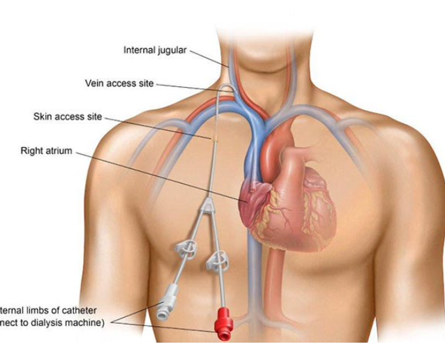 <p>&nbsp;A permacath ( or permcath) is a type</p><p class="p1">tunnelled central venous access</p><p class="p1">device.</p><p class="p1">• It is a split catheter – this means that</p><p class="p1">the two lumens have unequal</p><p class="p1">lengths</p><p class="p1">• One opening is a few cm distal to</p><p class="p1">the other to give a staggered</p><p class="p1">opening</p><p class="p1"></p><p class="p1">• Permacaths are used for dialysis</p><p class="p1">• Long term access (months - years)</p><p class="p1">• Wide bore catheter, 14.5 F</p><p class="p1">• Various lengths 19cm -31cm</p><p class="p1">• Sutured in place</p><p class="p1">• Inserted by a radiologist in angio</p><p class="p1"></p><p class="p1">• Given the patient’s dependence on this therapy, these devices must not</p><p class="p1">be accessed outside of dialysis unless urgent access is required and this</p><p class="p1">has been authorized by a medical lead.</p><p class="p1">• Dialysis catheters must only be accessed by renal trained clinicians.</p><p class="p1">• Be aware that dialysis catheters are usually ‘locked’ with high</p><p class="p1">concentrations of heparin to prevent blockages.</p><p class="p1"></p><p class="p1">Non-accessible cap:</p><p class="p1">To deter inappropriate access of dialysis-</p><p class="p1">dedicated devices by clinicians who are</p><p class="p1">not dialysis-trained.</p>