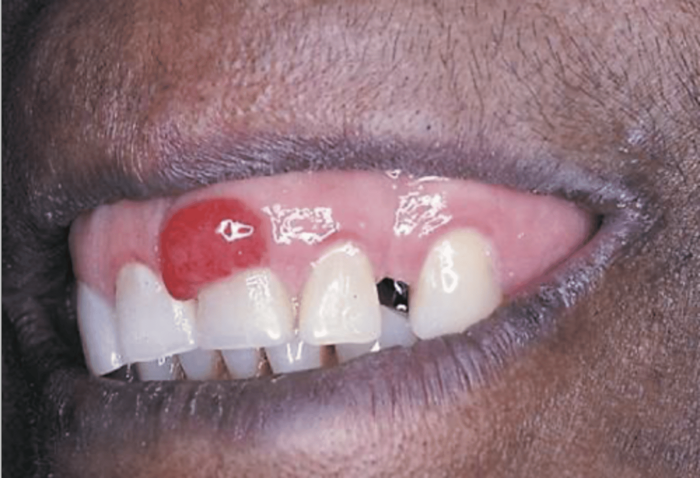 <p>Pyogenic granuloma</p><p>Pyogenic granuloma is a reactive inflammatory response to injury. It is not a variant of normal. </p><p>Fordyce granules are seen in more than 80% of adults over 20 years of age and are considered a variant of normal. </p><p>Leukoedema is observed in about 85% of black individuals and is considered a variant of normal. </p><p>Linea alba is located on the buccal mucosa along the occlusal plane of the teeth. It is most prominent in patients who have a clenching or bruxism habit. It is so common that it is considered a variant of normal.</p>