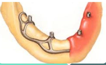 <p>What are subperiosteal implants made of?</p>