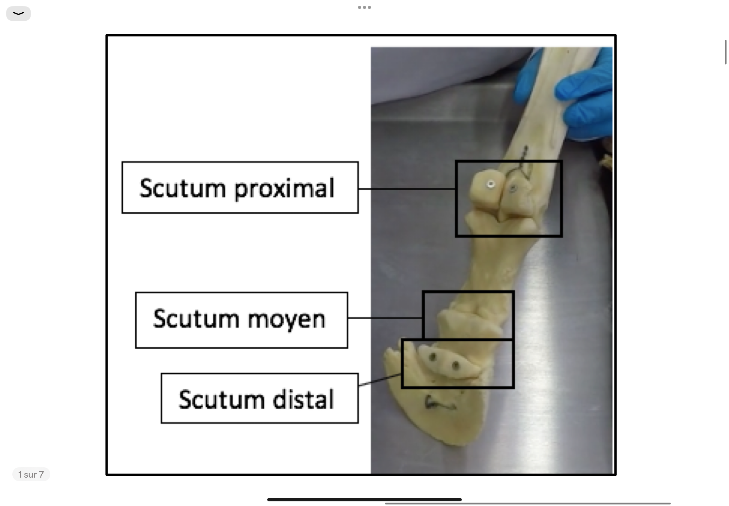 <p>Scutum = bouclier en latin, c’est donc une surface lisse arrondie qui servira de surface de glissement pour les tendons des fléchisseurs</p><p>‣ Le scutum proximal est formé par les os sésamoïdes proximaux qui sont réunis par un gros ligament fibro-cartilagineux qui est le ligament intersésamoïdien.</p><p>‣ Le scutum moyen est formé par un fibro-cartilage qui est fixé sur le bord proximal de P2</p><p>‣ Le scutum distal est formé par le sésamoïde distal (fibro-cartilage sur la facies flexoria).</p>