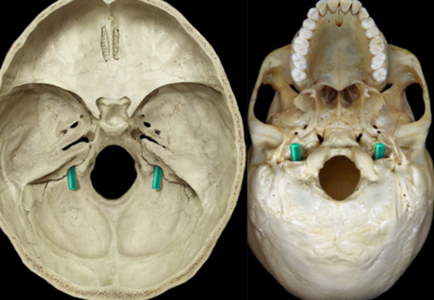 <p>dips that are lateral jugular foramina</p>