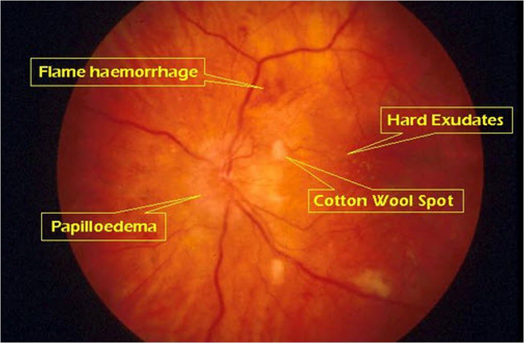 <p>opaque arterial wall, AV nicking, flame hemorrhage, papilledema, cotton wool, hard exudates, silver/copper wire</p>