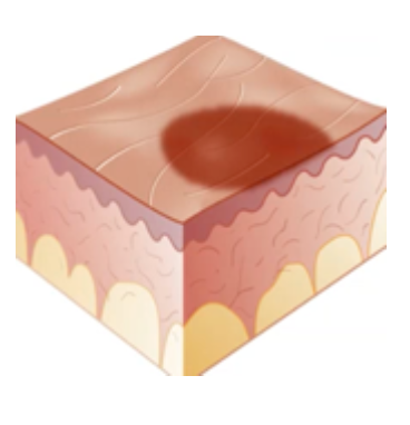 <p>Primary Skin Lesion</p><ul><li><p>Any <strong>flat</strong> discolored lesion of <strong>less than 1 cm</strong> with <strong>circumscribed border</strong></p></li><li><p>E.g., cherry angioma</p></li></ul><p></p>