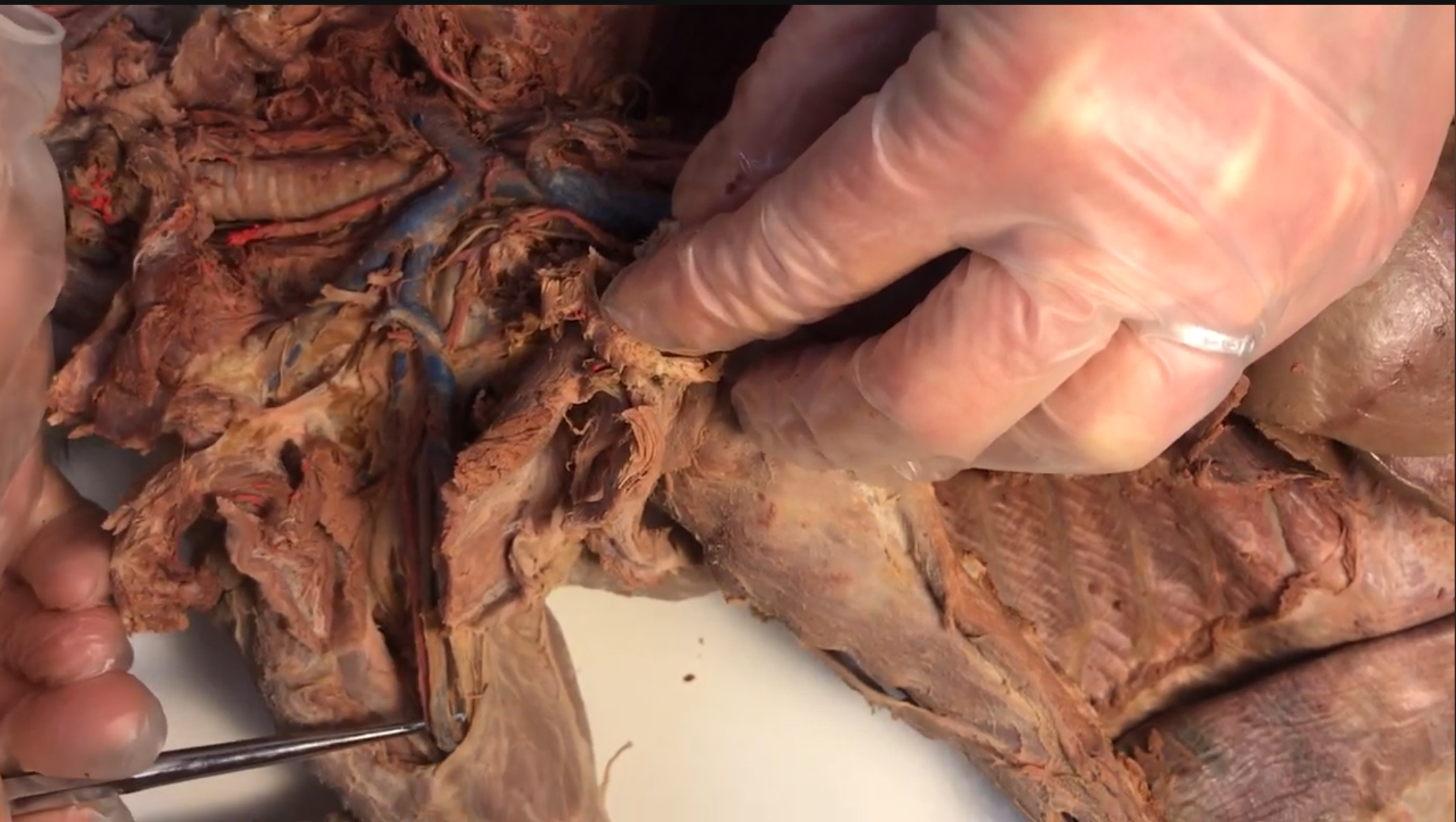 <p>What artery is this</p>