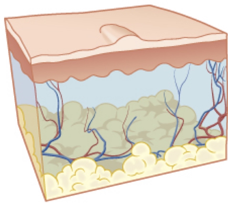 <p>Small, raised bumps on the skin</p><p>Similar to a mosquito bite</p><p>Can be firm and a variety of colors</p>