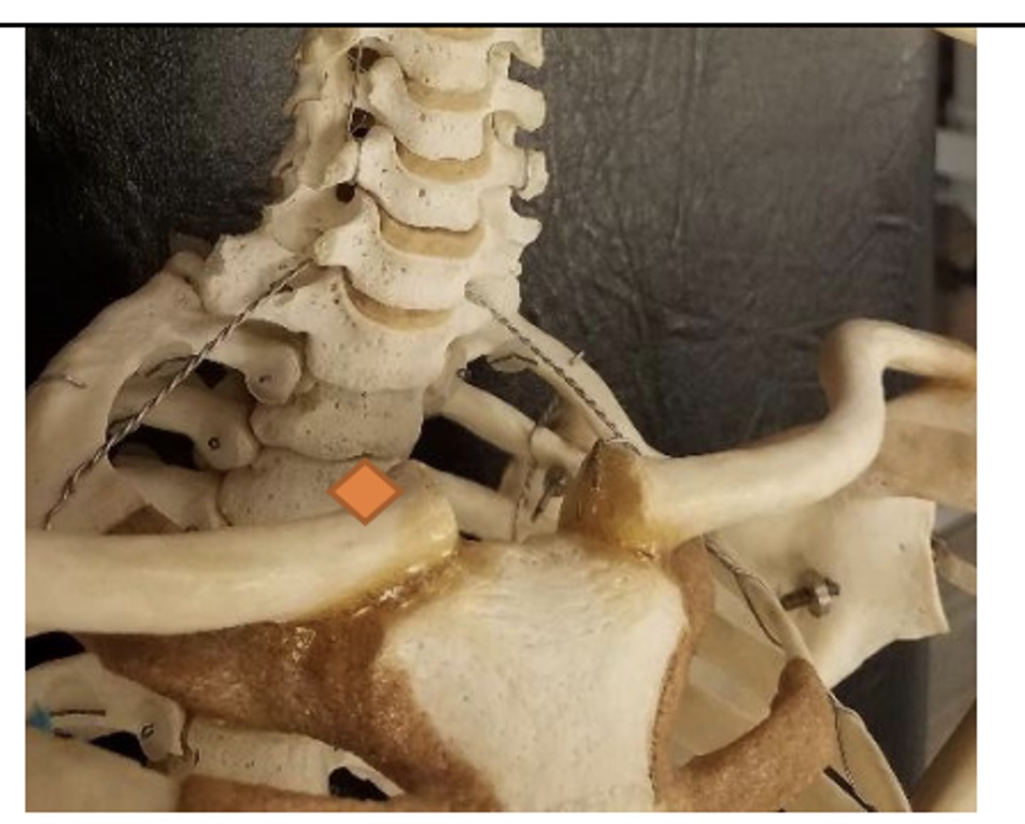 <p>superior aspect of medial end of clavicle (lateral to SC joint)</p>