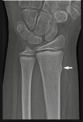 <p>What kind of fracture is this?</p>