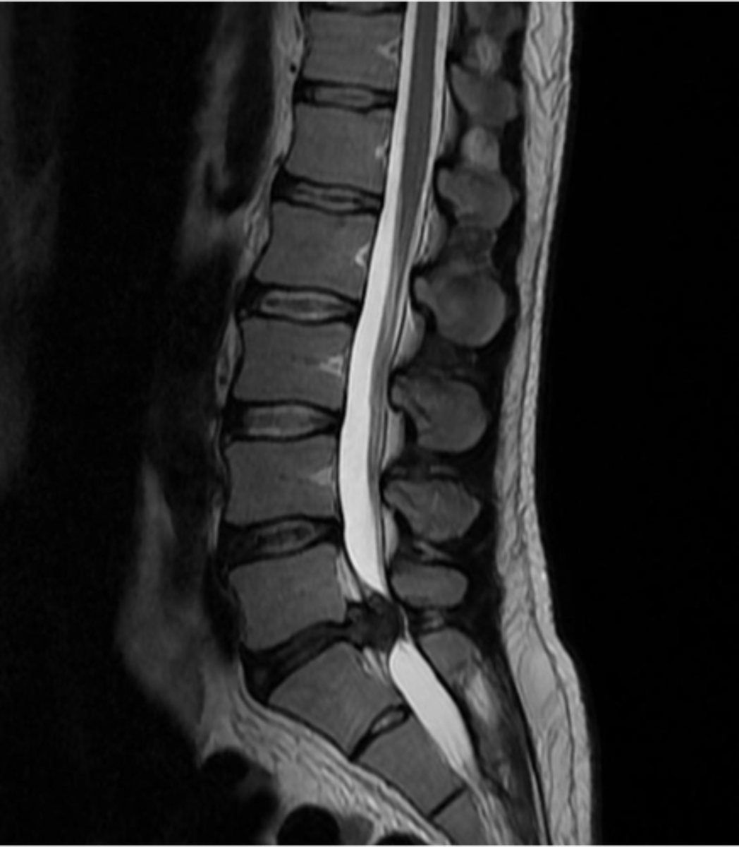 <p>spinal stenosis</p>
