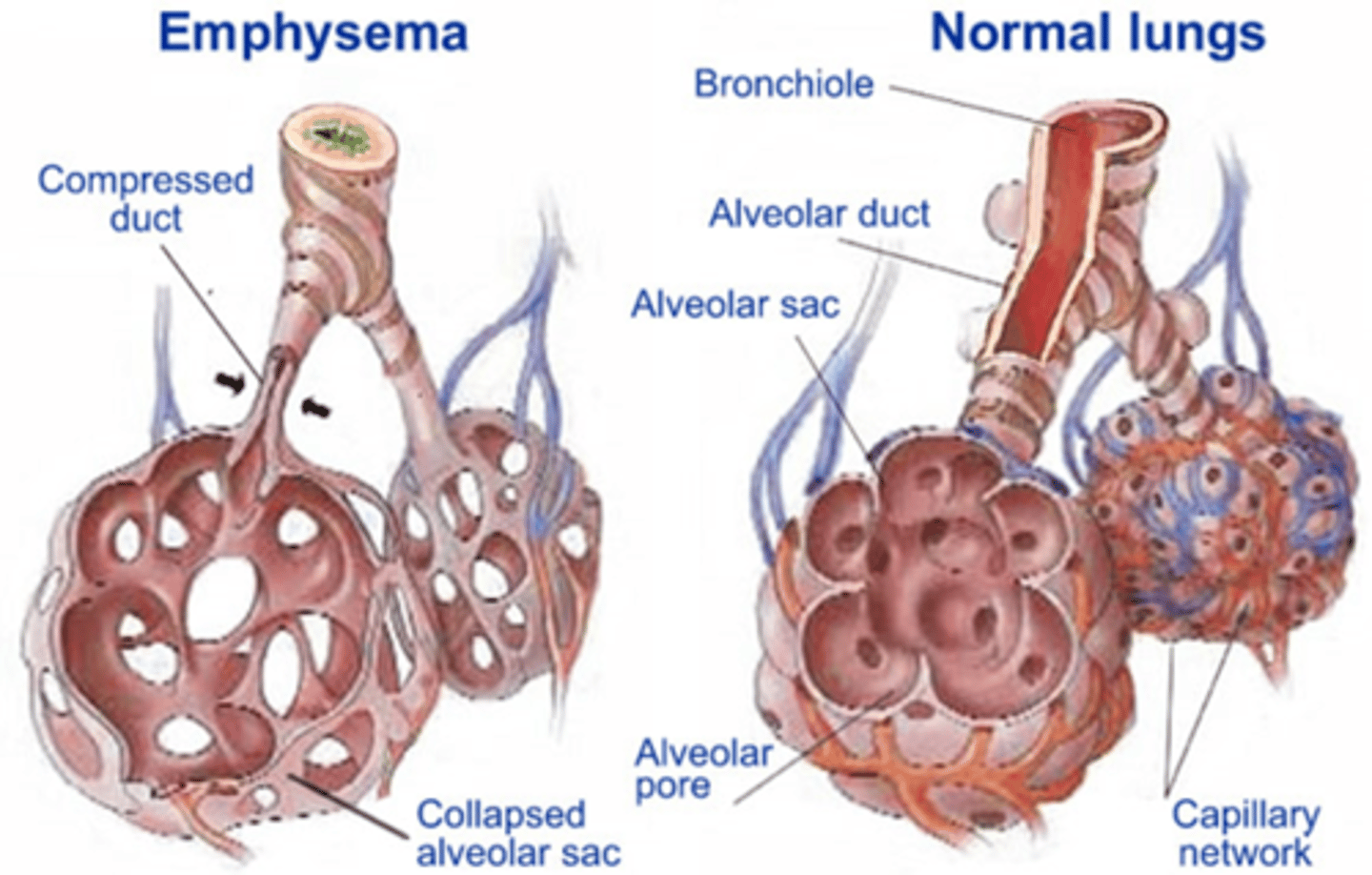 <p>Permanent enlargement of the alveoli/terminal bronchioles due to parenchymal destruction by oxidative stress, inflammation and protease imbalance</p>