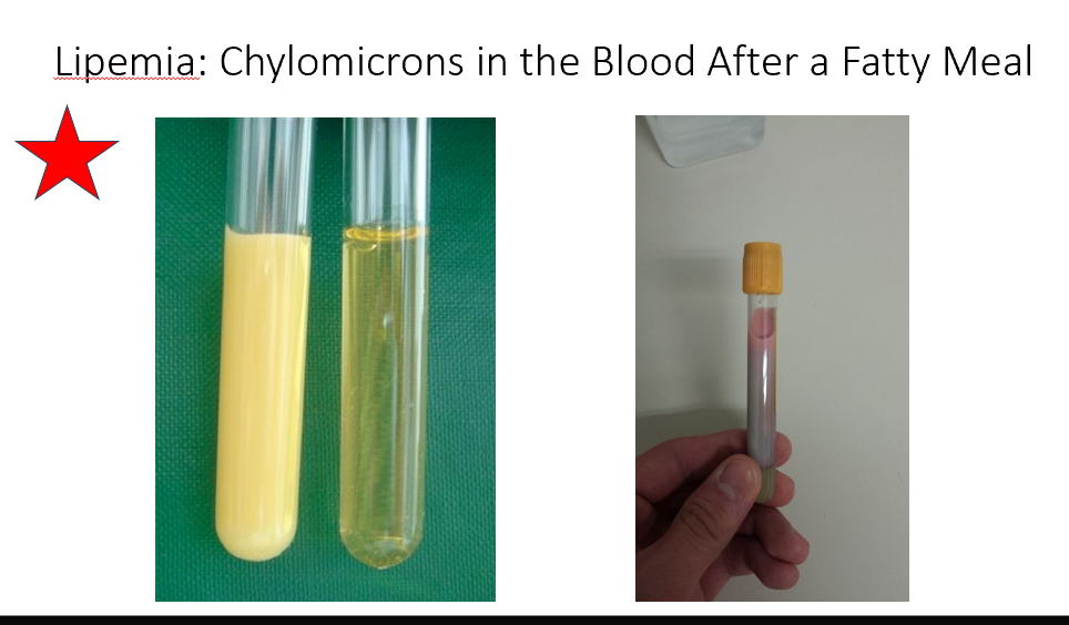 <p>Chylomicrons in the Blood After a Fatty Meal</p>