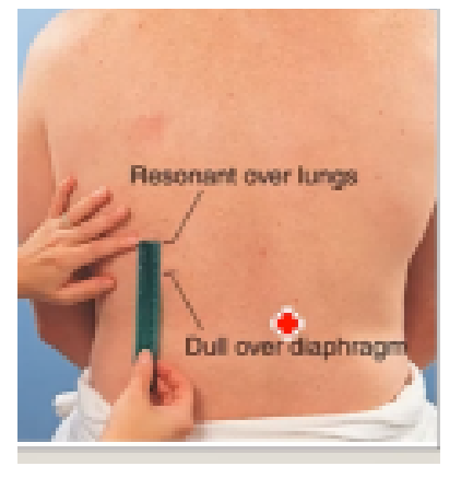 <p>(percussion)</p><ol><li><p><span>ask the client to exhale forcefully and hold the breath, </span></p></li><li><p><span>beginning at the scapular line (T7), percuss the intercostal spaces of the right posterior chest wall</span></p></li><li><p><span>percuss downward until the tone changes from resonance to dullness. Mark this level and allow the client to breathe: </span></p></li><li><p><span>n</span>ext ask the client to inhale deeply and hold it.</p></li><li><p>p<span>ercuss the intercostal spaces from the mark downward until resonance changes to dullness.</span></p></li><li><p><span>mark the level and allow the client to breathe. </span></p></li><li><p><span>measure the distance between the two marks. </span></p></li><li><p><span>perform this assessment technique on both sides of the posterior thorax.</span></p></li></ol><p></p>