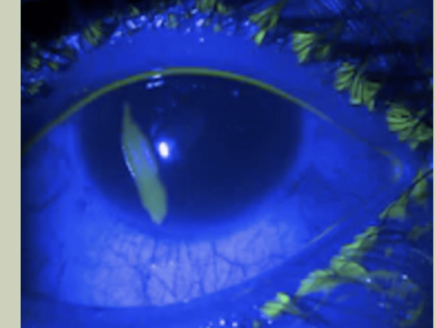 <p>-Unilateral</p><p>-Hx of injury to eye</p><p>-SX: intense ocular pain, redness, photophobia, tearing that follows injury to eye</p><p>-Signs: redness, epithelial defect that stains FI</p><p>-TX: prophylactic topical abx BID, refer to ECP next day for monitoring</p>