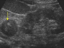 <p>What is the pathology seen here?</p>