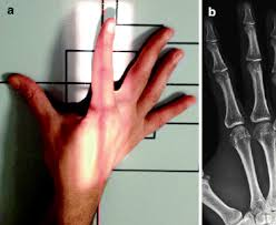 <p>Proximal interphalangeal (PIP) Joint</p>