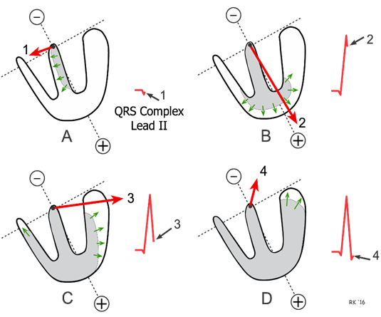 <p>Ventricular depolarisation towards apex, parallel to lead II so positive deflection</p><p><strong>depolarisation </strong>towards positive <strong>electrode</strong></p>
