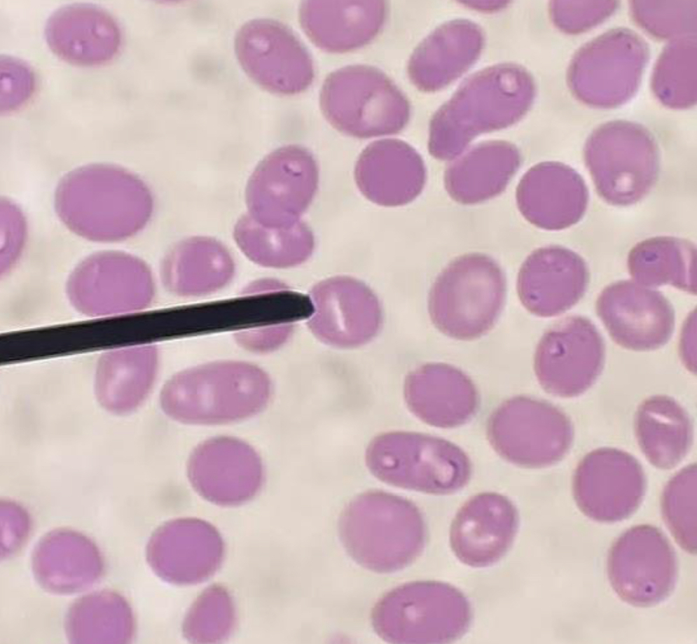 <p>A. Identify the pointed cell</p><p>B. Describe the striking feature</p><p>C. Associated with what condition?</p><p>D. What is the main defect of this cell?</p>