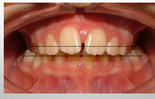 <p>-present when posterior teeth occlude in an abnormal buccolingual relation with the antagonistic teeth</p><p>-can be result of either malposition of a tooth or teeth, and/or the skeleton</p><p>-examining the transverse dimension allows us to evaluate the intermolar and intercanine widths and determine which arch is the offending unit</p><p>-posterior crossbites can be unilateral or bilateral</p><p>-a functional crossbite results from an occlusal interference that requires the mandible to shift either anteriorly and/or laterally in order to achieve maximum occlusion</p>