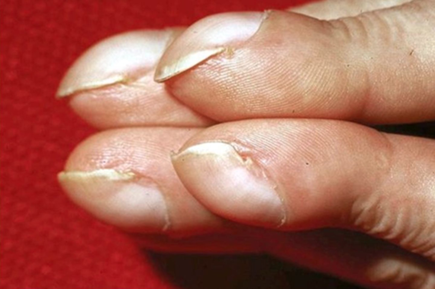 <p>Enlargement of fingertips due to chronic hypoxia.</p>
