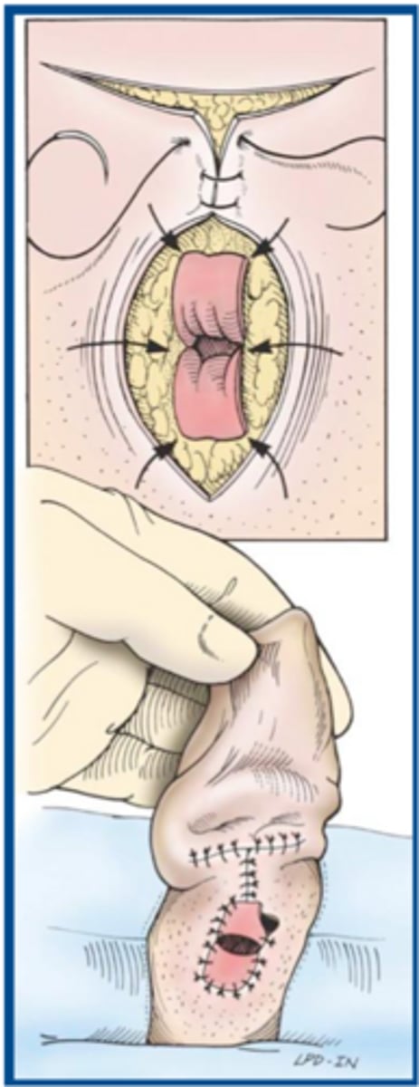 <p>when might the vertical ear canal ablation be the technique of choice</p>