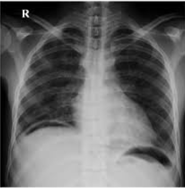 <p>free air under the diaphragm<br><strong>abnormal finding, </strong><span style="color: red"><strong>perforated until proven otherwise</strong></span></p><p><em>Abdominal Radiograph</em></p>