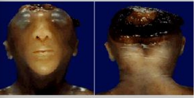 <p>brain and skull not formed properly </p>