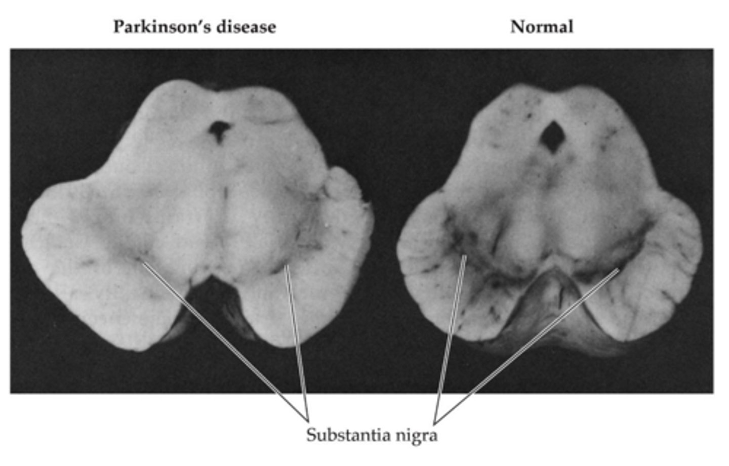 <p>-Neurons in the sub. nigra die in PD, neurons can't make it to the striatum</p><p>-Death of nigrostriatal pathway</p><p>-Significant loss of visible black (loss of neurons)</p>