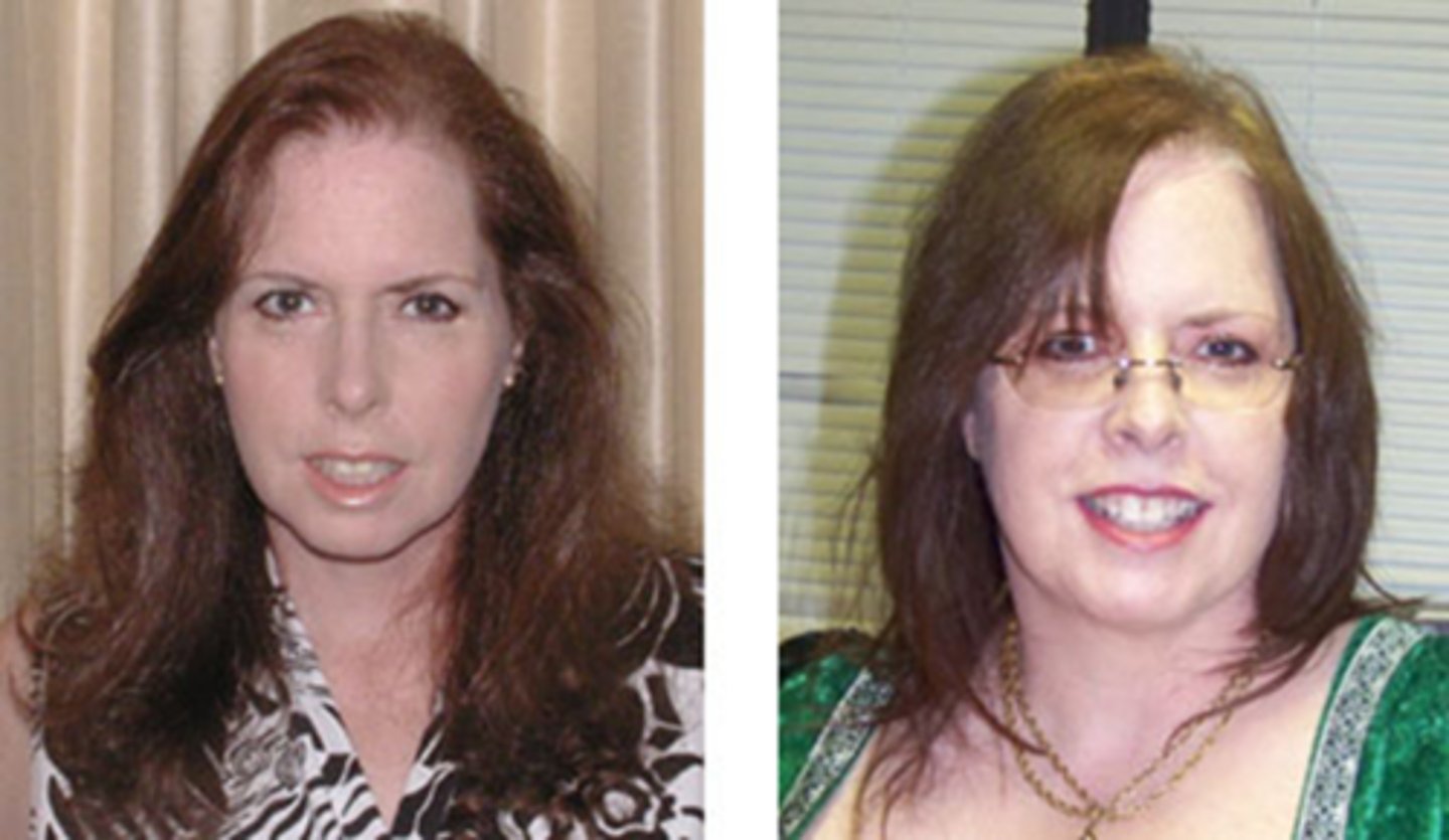 <p>Recall: what are some side effects of <strong>oral steroids</strong>?</p>
