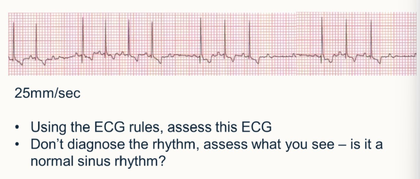 <p>Using ECG rules, assess this ECG</p><ul><li><p>assess what you can see</p></li><li><p>is it normal sinus rhythm</p></li></ul><p></p>