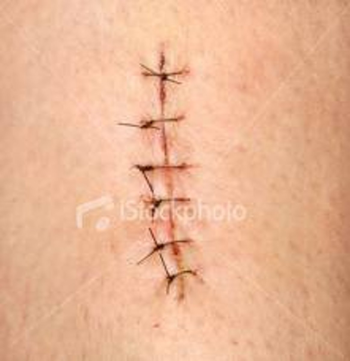 <p>a stitch</p>