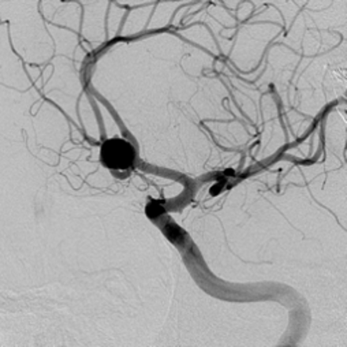 <p>Gold standard for detection of aneurysm and surgical planning (urgent to ID aneurysm --> surgery)... visualize --> surgery</p><p>Image:</p><p>- ICA --> MCA and ACA</p><p>- black dot = aneurysm in ACOM area</p>