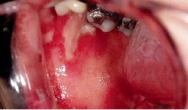 <p>What is the first-line medication for Squamous Cell Carcinoma?</p>